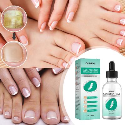 30ML 1FL OZ Toenail Fix Liquid na opravu nehtů, shnilých nehtů na nohou, lehkých nehtů na nohou, lehkých nehtů na nohou, světlých nehtů,