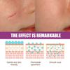 Ouhoe Scar Care Cream For Smoothing And Moisturizing Skin With Gentle Formula