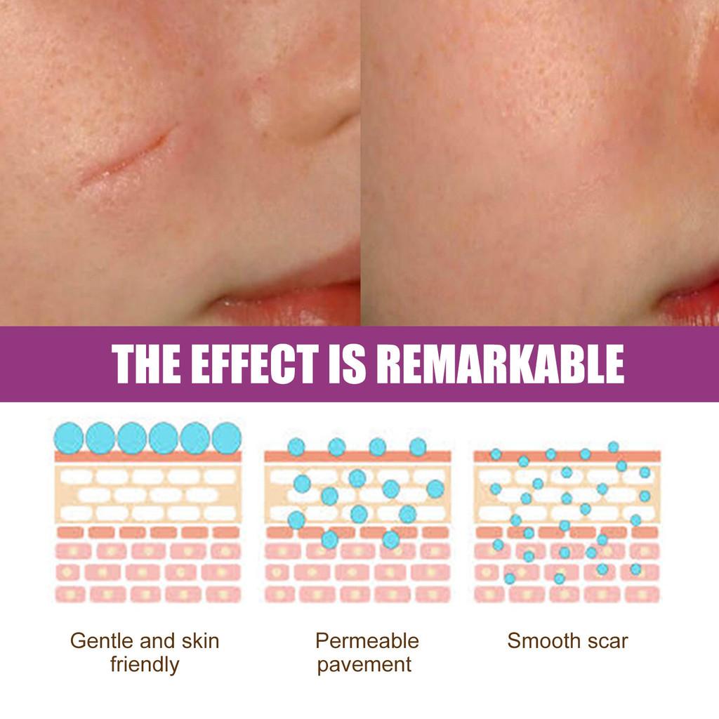 Ouhoe Scar Care Cream For Smoothing And Moisturizing Skin With Gentle Formula