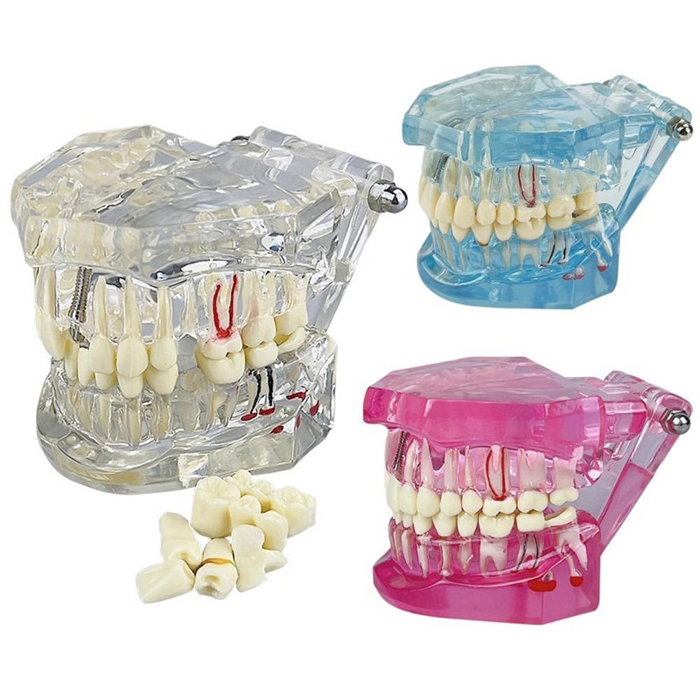 Teeth Model Implant Disease Dentist Studying Model With Restoration Bridge Tooth Demonstration Models For Patient Education