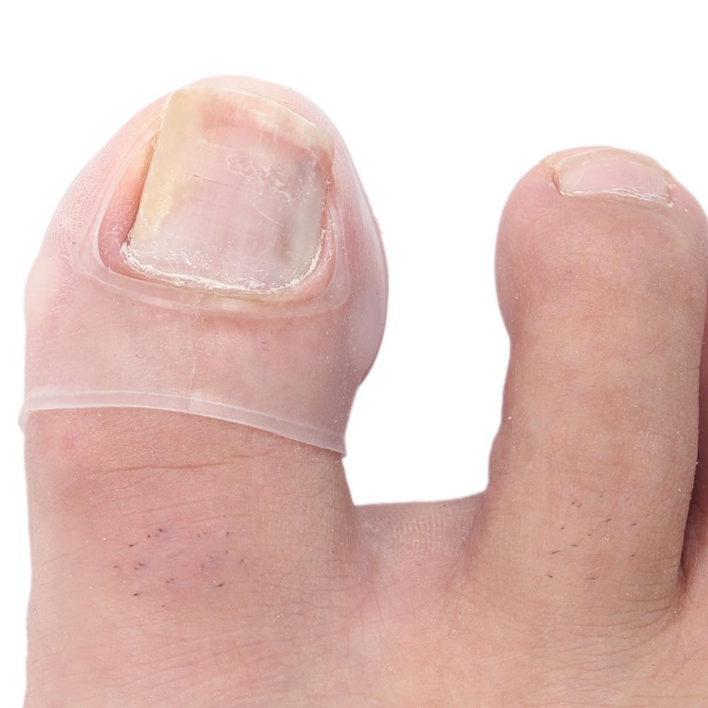 2pcs Silicone Ingrown Toenail Correcting Tool Pain Relief Paronychia Treatment Corrector