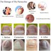 1Pcs Nail Correction Stickers Ingrown Toenail Corrector Patches Invisible High Strength Auxiliary Patch Paronychia Treatment