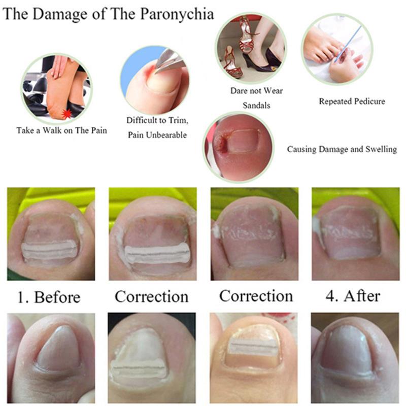1Pcs Nail Correction Stickers Ingrown Toenail Corrector Patches Invisible High Strength Auxiliary Patch Paronychia Treatment