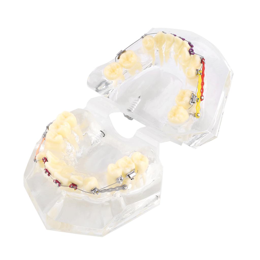 Dental Orthodontic Treatment Malocclusion Study Teeth Model With Wire Chain