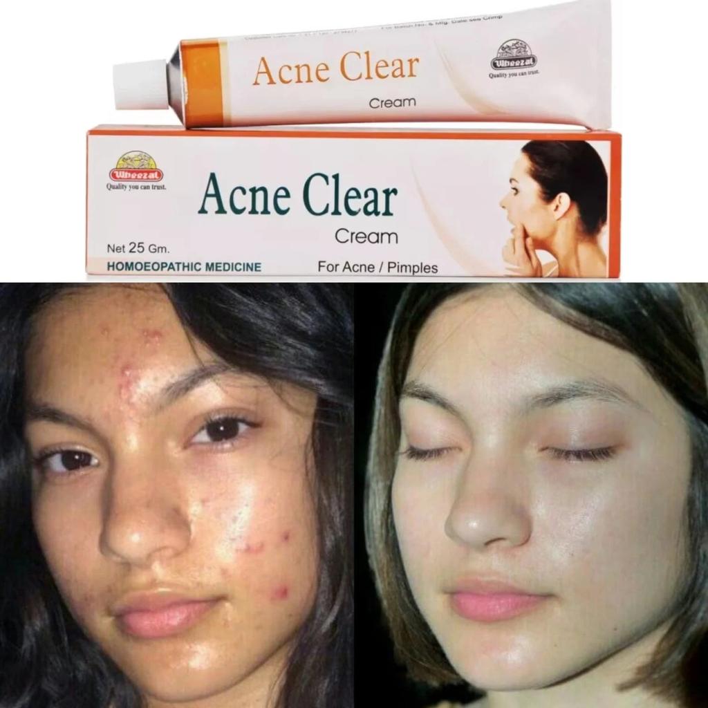 Wheezal Acne Clear Cream (25g) Nourishes Skin, Clears Acne, Pimples and Marks