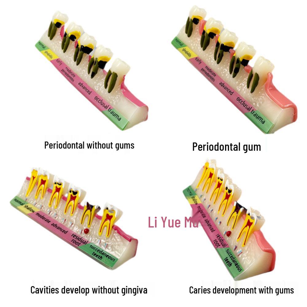 Dental Implant Teaching Model & Toothbrush Preparation Resin Mold