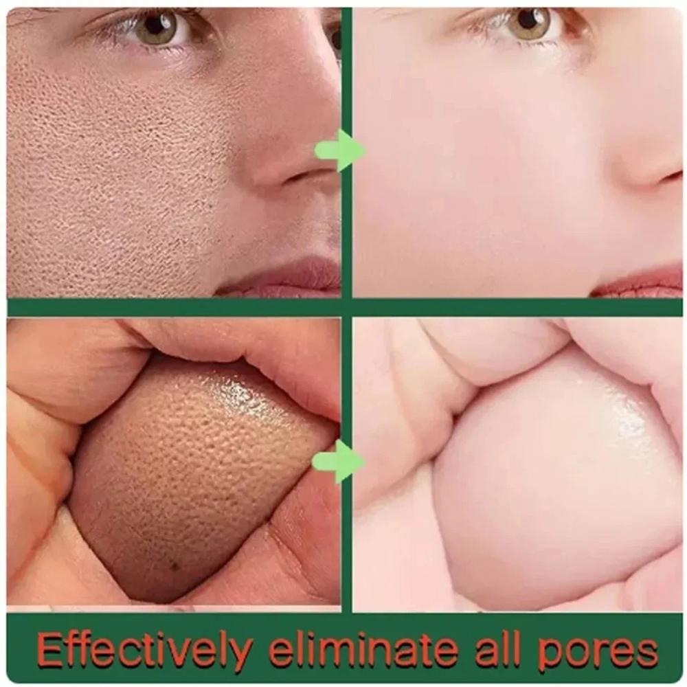 Salicylic Acid Acne Cream For Face Against Black Dots Acne Treatment & Open Pores Moisturizing Skin Care Cream - 50 g