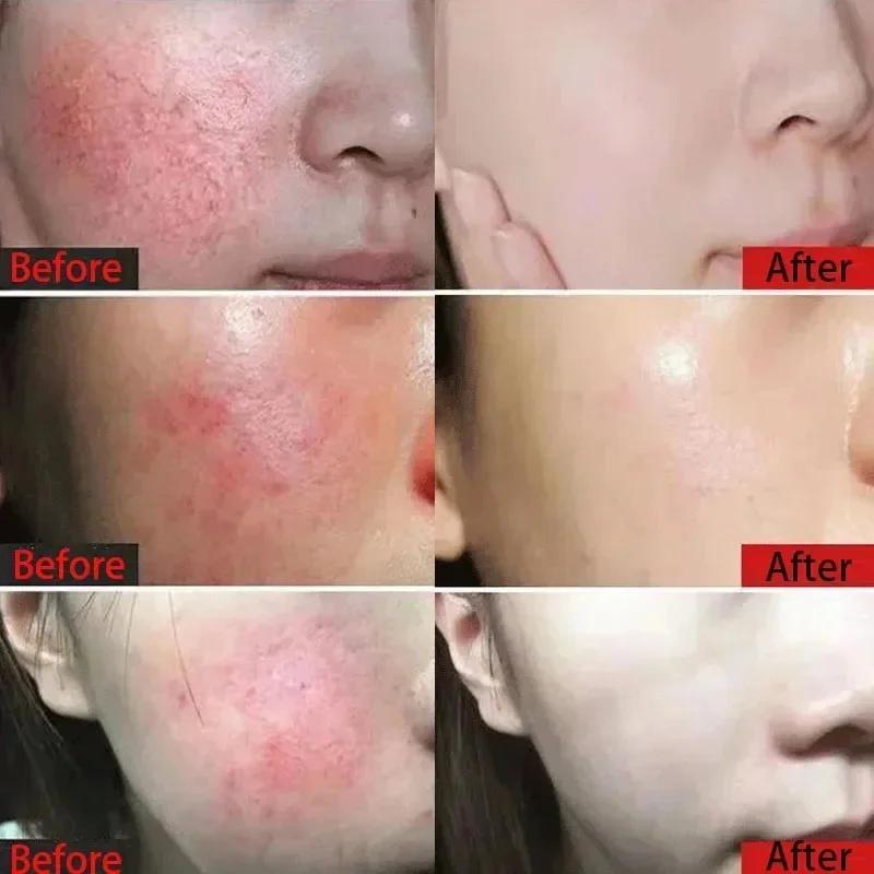 Crema Riparatrice Rossori Viso Lenitiva Pelle Sensibile Secchezza Idratante Lozione Idratante Rimozione Rosacea Cosmetici Coreani