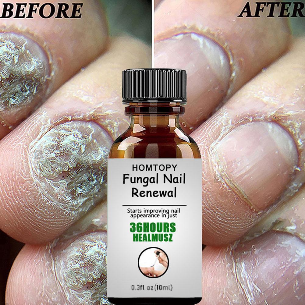 10ML Toenail Nail Fungus Treatment Repair Fingernail Device Foot Toenail Fungus Essential Care F0N3