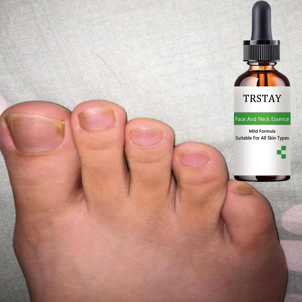7DAYS Repair Nail Fungus Treatments Essence Foot Care Serum Toe Nails Fungal Removal Gel Anti-Infection