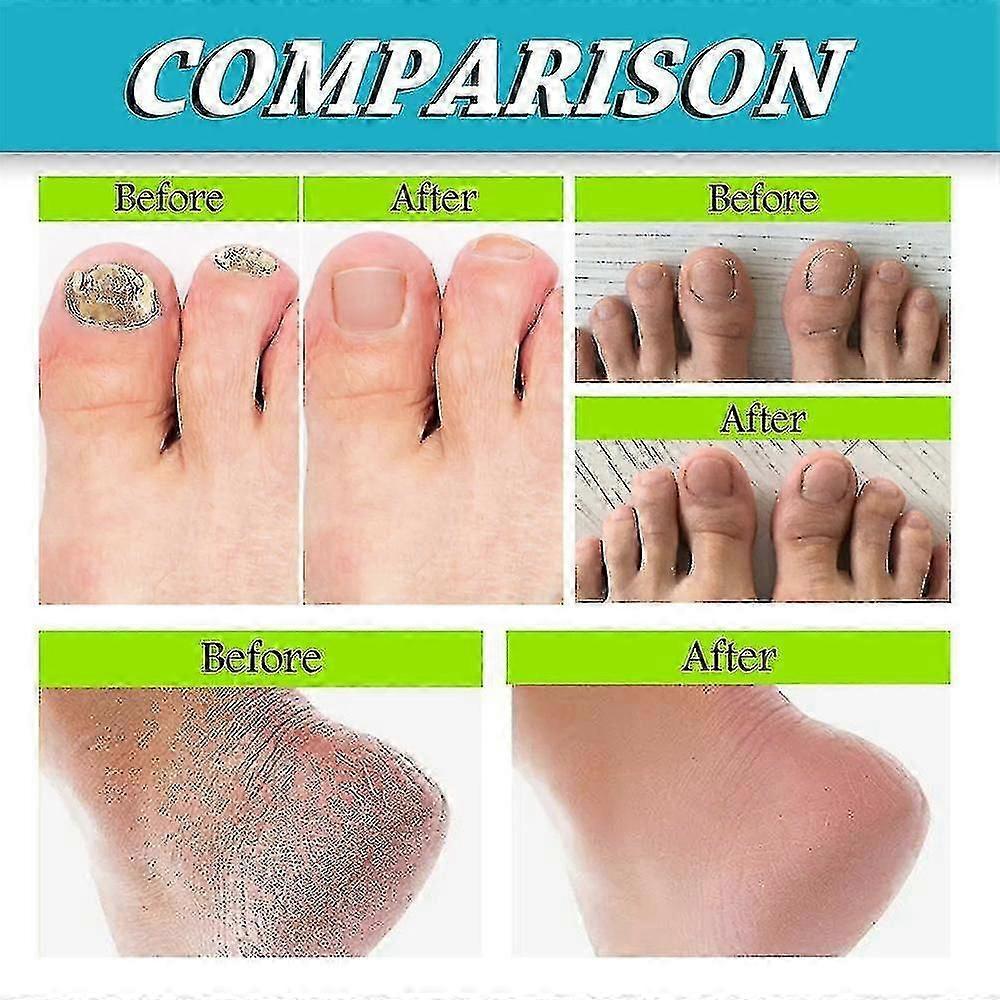 3 Pezzi Spray per Piedi e Unghie, Cura Naturale e Potente per i Piedi - Quan
