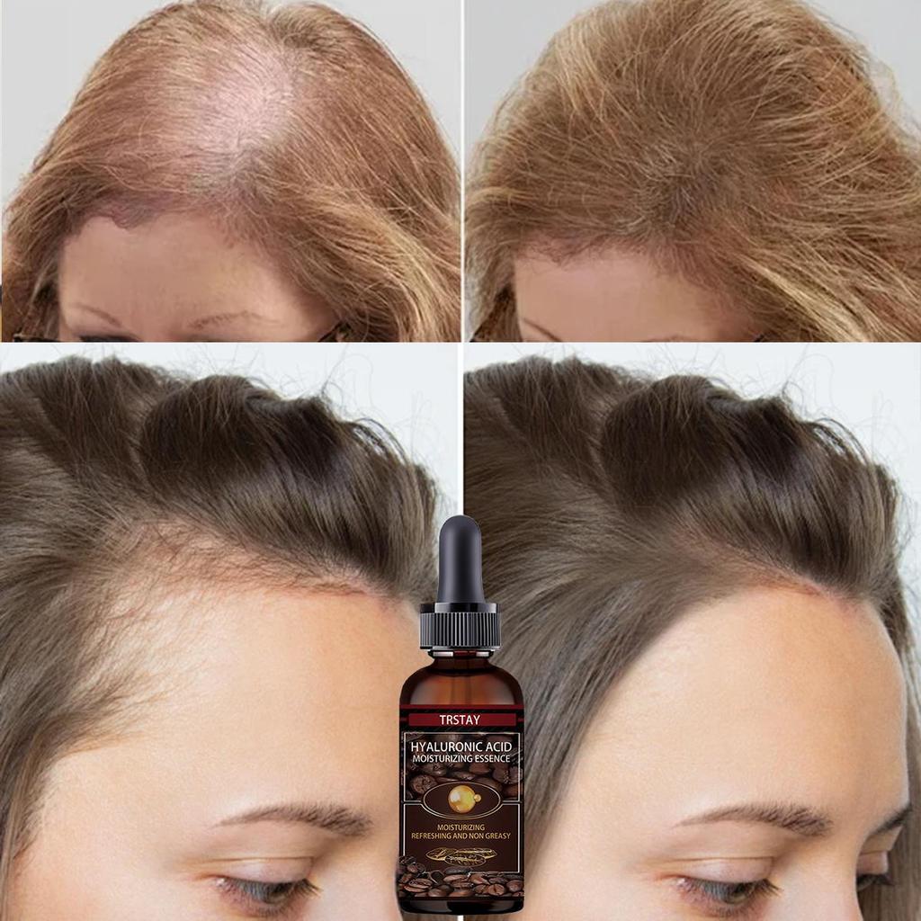 Haartransplantationsserum, ätherisches Öl, beschleunigt das Wachstum