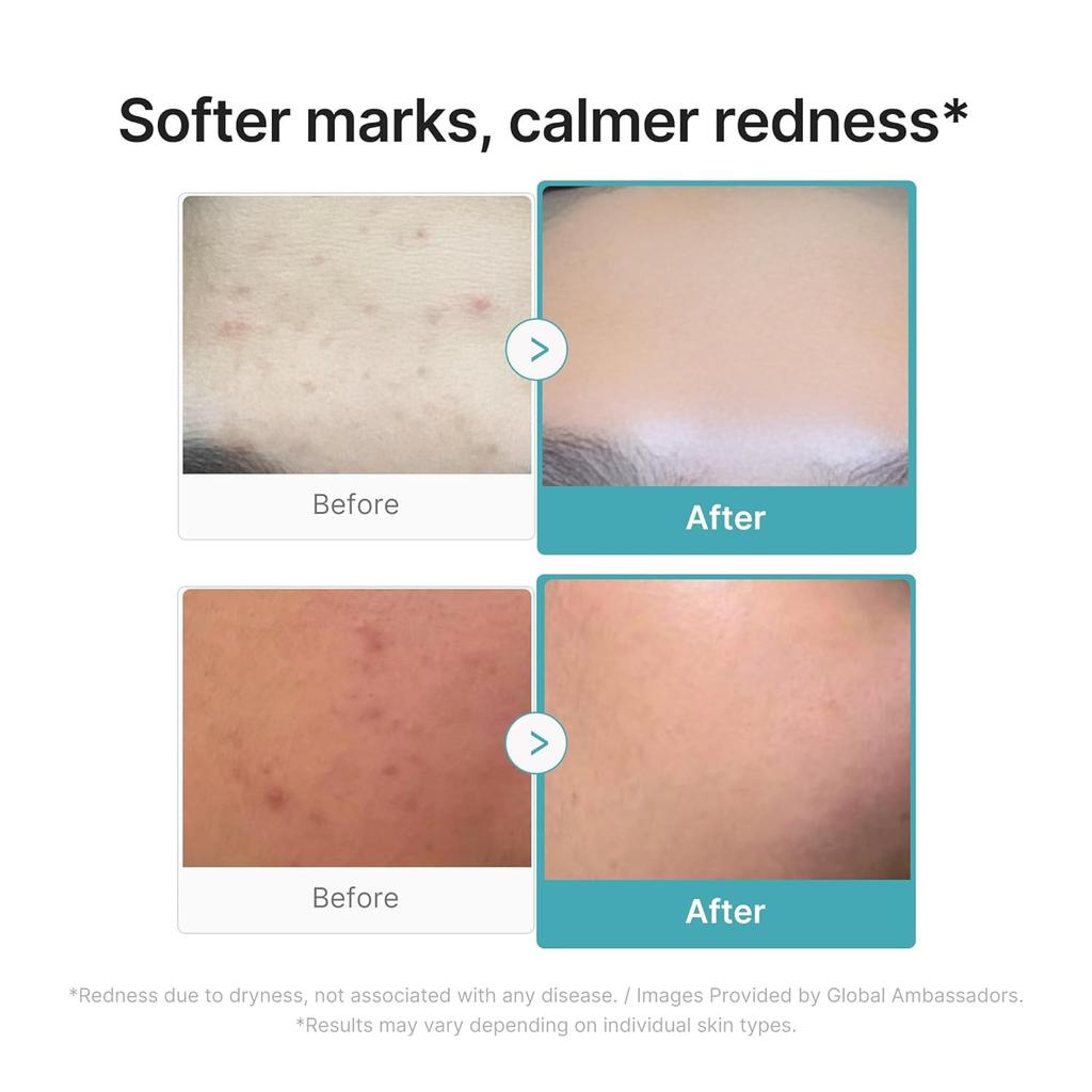 Medicube Azelaino rūgštis 10 BB Raminamasis serumas 30ml