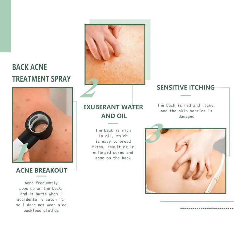 Jaysuing Back Acne Repair Spray For Effective Blemish Treatment And Skin Smoothing
