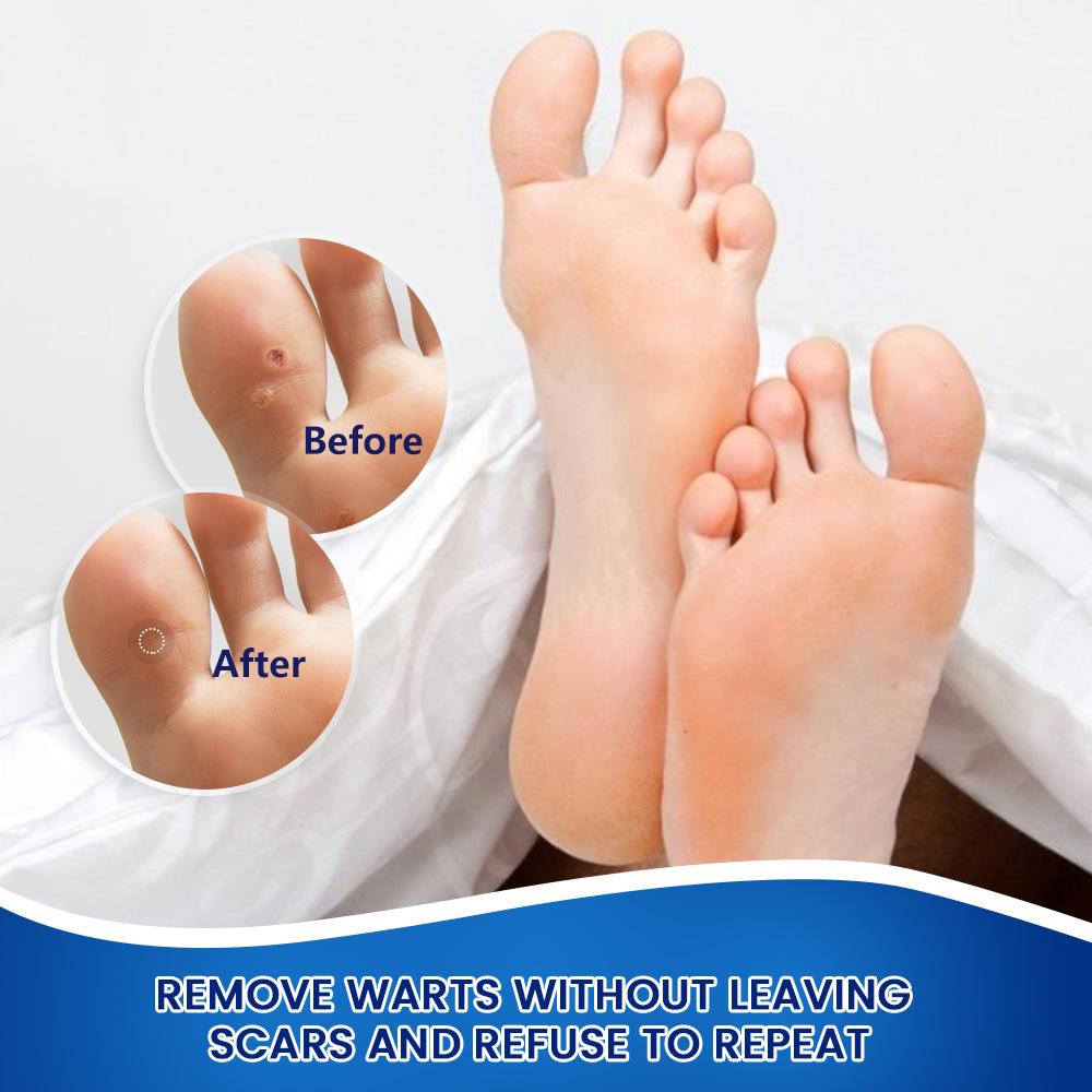 20G Foot Corn Removal Killer Foot Protection Pain Relief Curative Cream Medical Corns Plaster