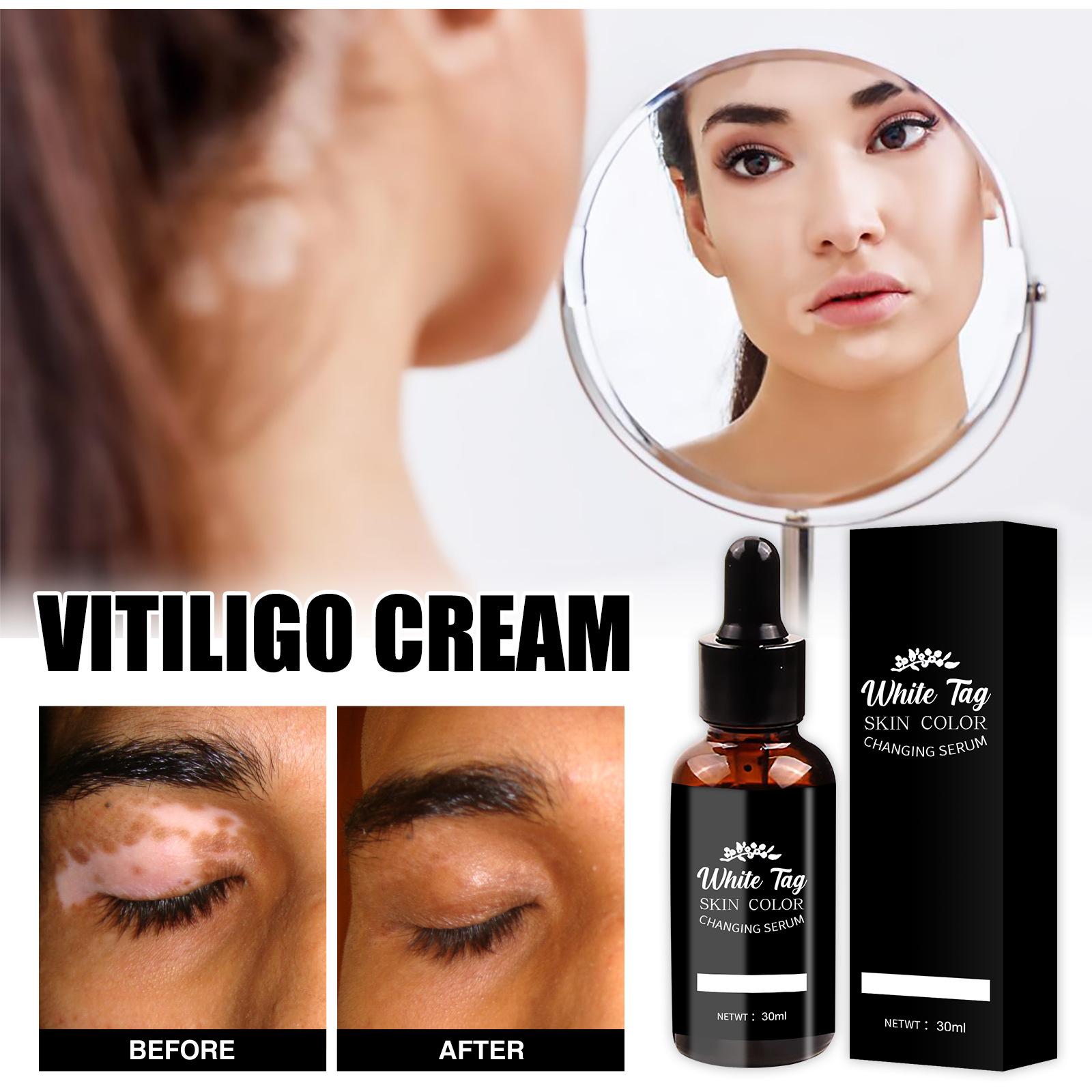 

Vitiligo Essence Light Spot Увлажняющий уход за кожей Нежная эссенция