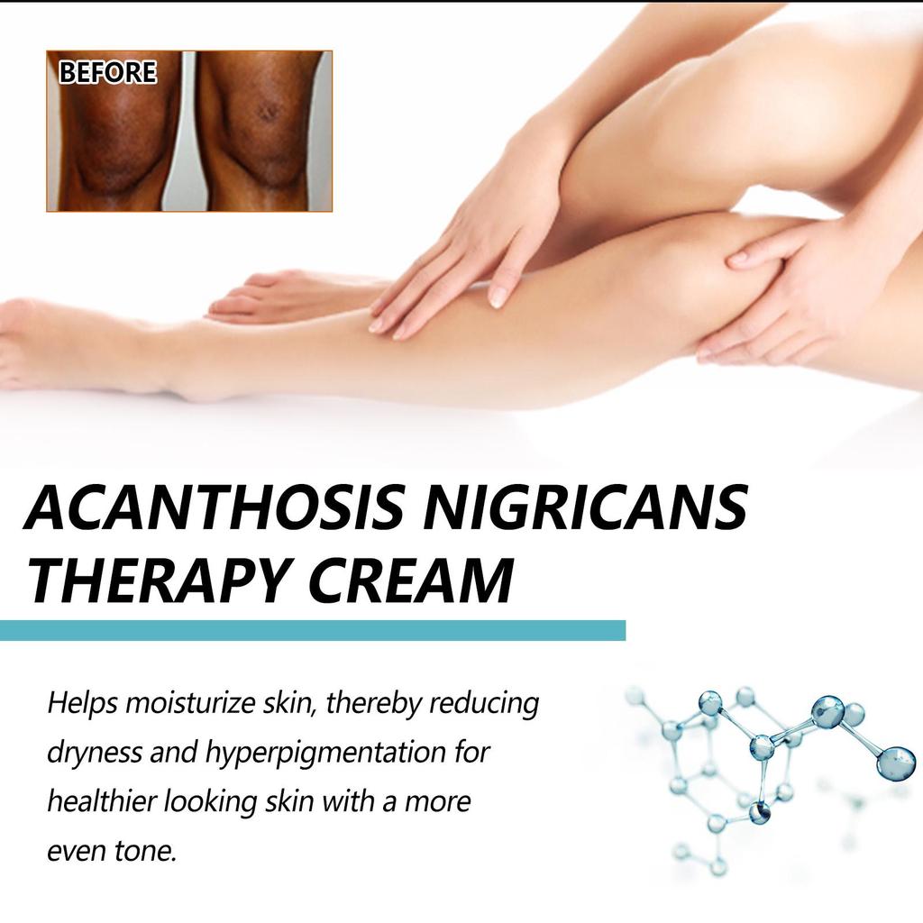 Spot Remover For Body,Spot Corrector Cream,- Underarm, Neck, Armpit, Knees, Elbows, Private Areas, Intimate Areas