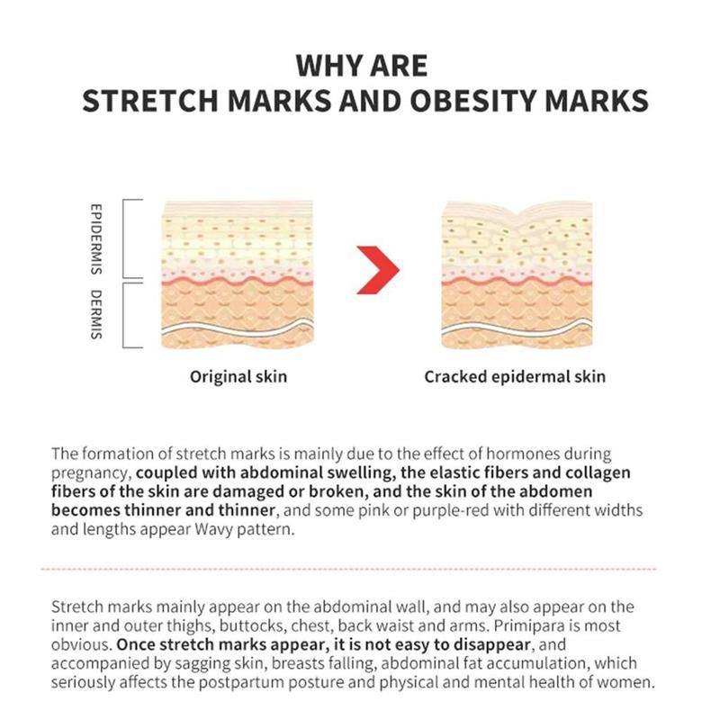 Removal Acne Scar Stretch Marks Cream Fat Scar  Treatment