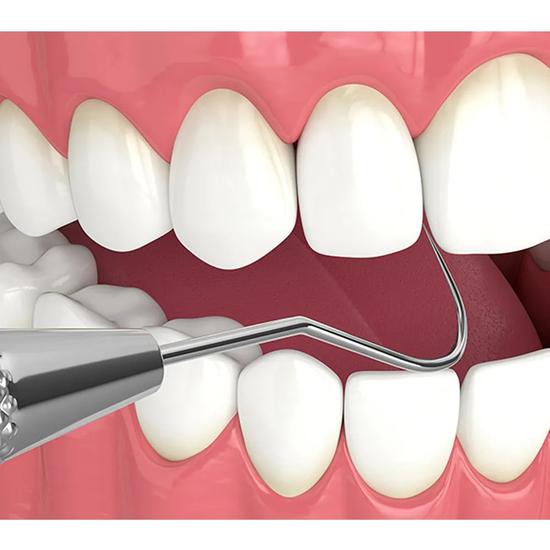 GDC Single End Probe -1 (Exs23)