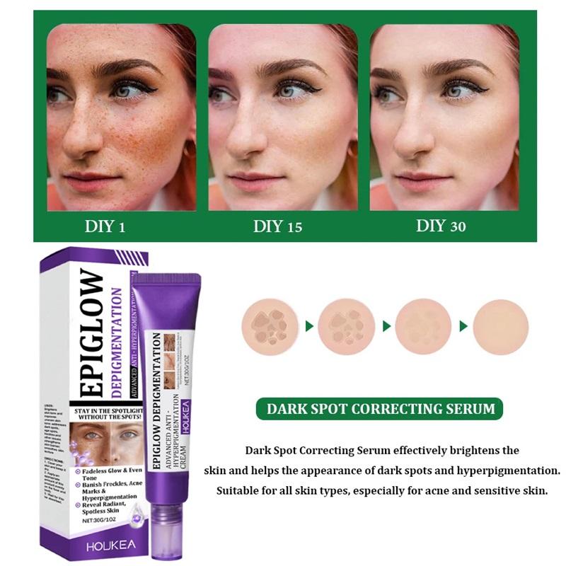 Freckle Whitening Cream Melasma Dark Spots Pigmentation Removal Product Fade Stain Melanin Fast Repair Brighten Korean Skin Car