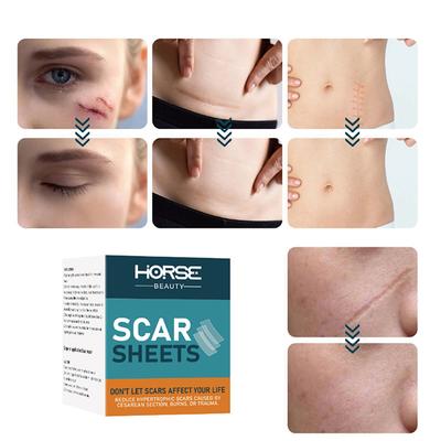 Professional Silicone Gel Scar Sheet Patch Treatment Removal Tape Acne Trauma Burn Scar Cover Skin Repair Section Ear Beauty