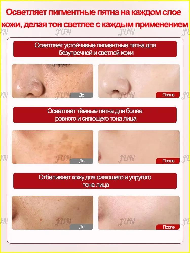 Retiderm anti-aging face cream, Freckle removal and whitening cream is able to remove freckles, chloasma, sunspots, age spots, Contains hyaluroni
