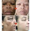 Whiten Cream Brighten Face Effective Remove Melasma Dark Spot Improve Dullness Skin Anti-pigmentation Care Cream Care Products