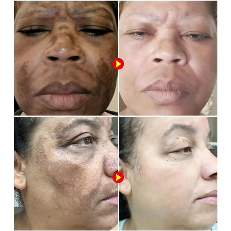 Whiten Cream Brighten Face Effective Remove Melasma Dark Spot Improve Dullness Skin Anti-pigmentation Care Cream Care Products