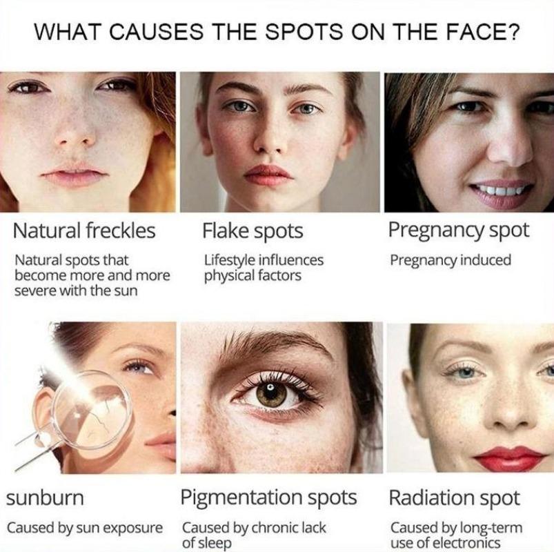 Cea mai nouă cremă de albire pentru față cu vitamina C, care repara pistruii decolorați, îndepărtează petele întunecate Cremă de față pentru înlăturarea melaninei