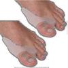 3 Paar X Gel Hallux-Valgus-Korrektor Zehenschützer Begradiger Separatoren Zehenspreizer (6 Stück) - chuan