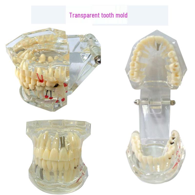 Dental Implant Teaching Model & Toothbrush Preparation Resin Mold