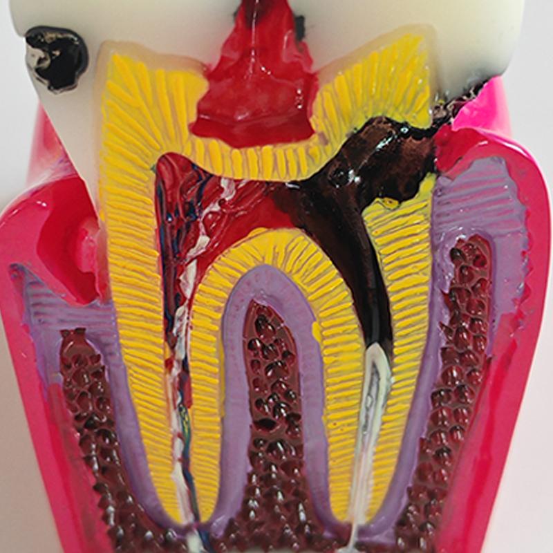 Newest 6X Caries Comparison Teeth Model For Dental Student Demonstration Teaching Dentistry Anatomy Study Research