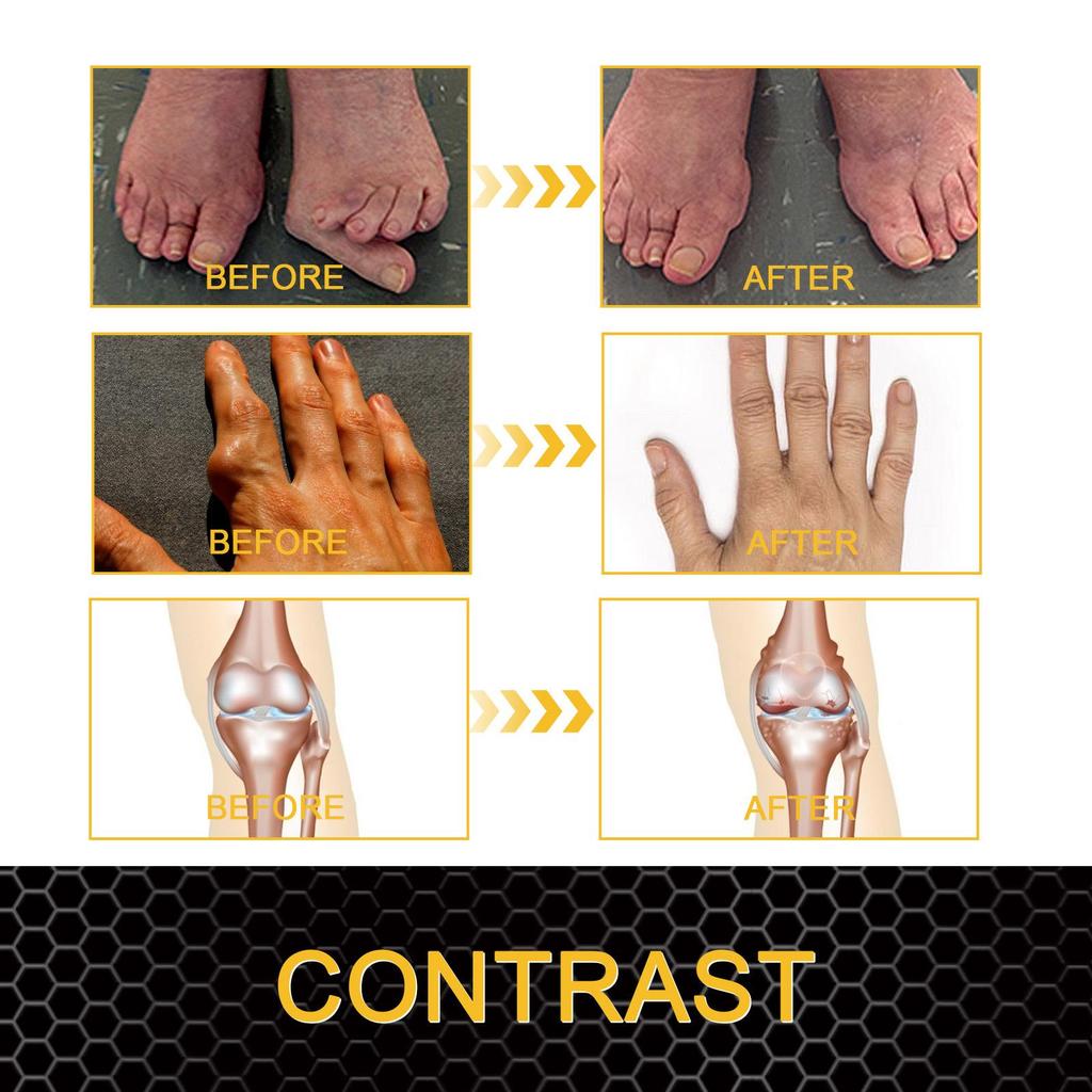 20g Bee Venom Joint Care Gel Relieves aching muscles and bones with gentle care to improve joint stiffness and discomfort.