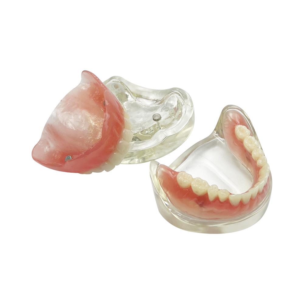 Modelo de Implante Dental 2 Implante Prótesis Completa Superior Inferior Modelo de Dientes Typodont Productos de Odontología Para Enseñanza Estudio