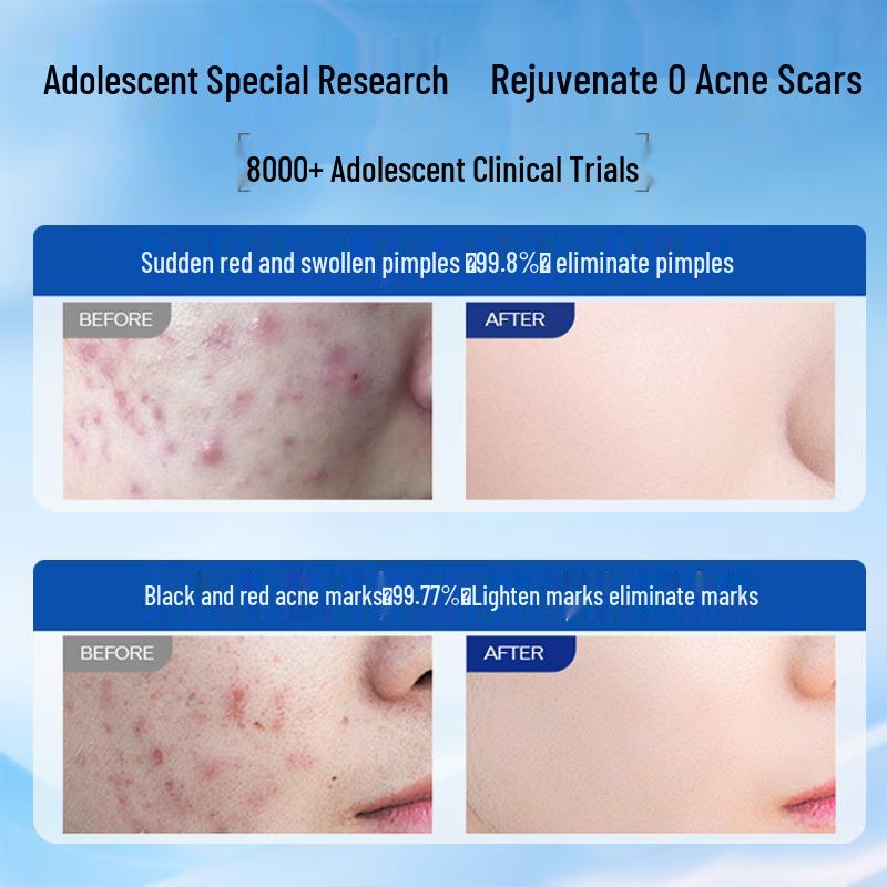 BEAUTY NOTES Teen Skincare for Acne & Blemishes