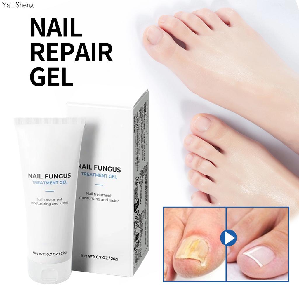 Nail Care Gel Hand Foot Onychomycosis Soft Nail Thickening Nail Luminescent Nail Repair Gel