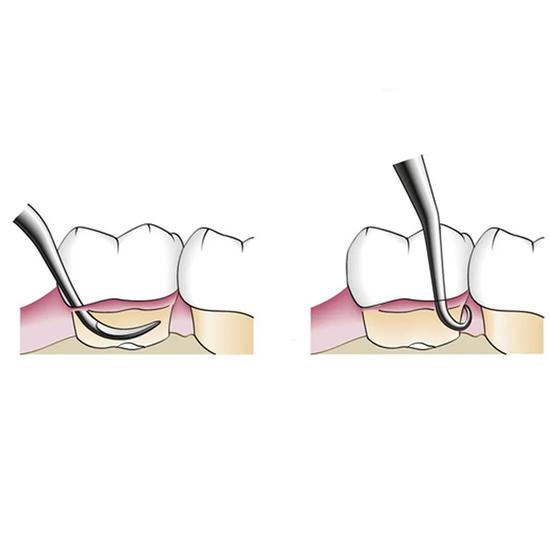 GDC Gracey Curettes Cc Distal Surfaces Of Posterior Teeth # 7 (Sgcc13/14)
