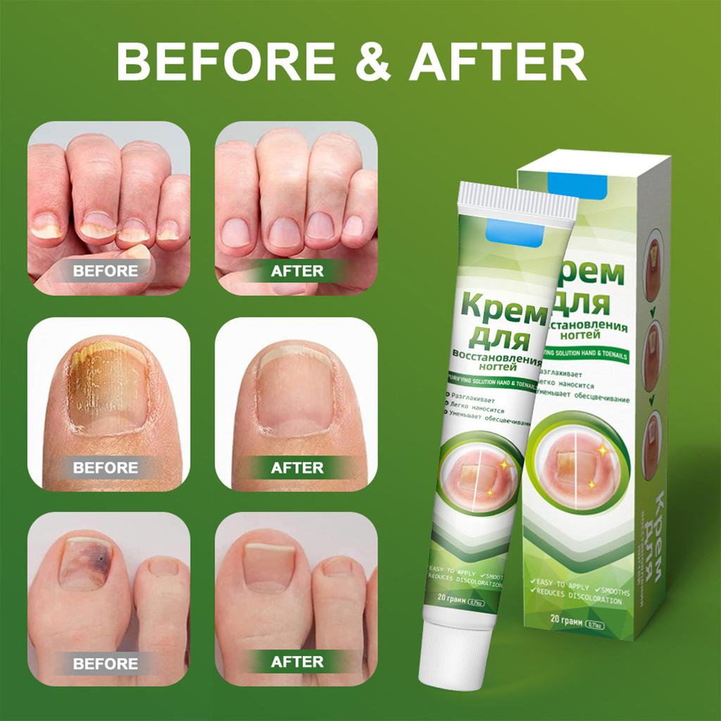 Plaster  Gray Nail Cream  New Bright Potassium Nail Cream  With File