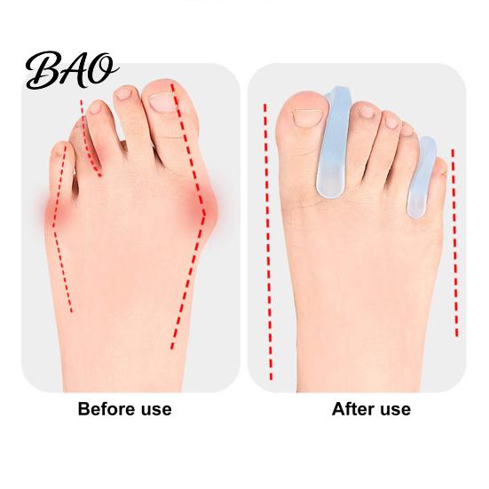Comfortable Toe Separator 2PCS Gel Separator, Soft Flared Spreader Straightener, Ultra-Thin Non-Slip A-shaped Bunion Corrector, for Overlapping