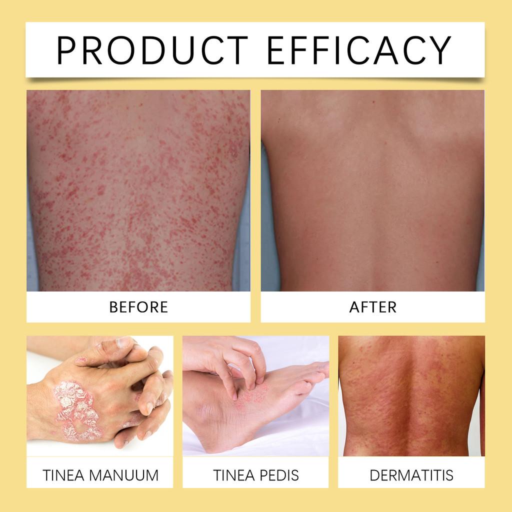 Nourishing Moisturizing Skin Cream South Moon Eczema Care Body Hands Feet 30g