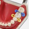 40 stücke/80 stücke/120 stücke Dental Elastische Gummi Befestigung Keile Interdental Keile Autoklavierbar Matrix Matrizen