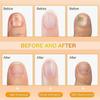 Bienenstich-Nagelreparaturserum, Natürliche Nagelpflege-Lösung, Zehennagel-Pflegespray, Beruhigende Nagelbehandlung, Anti-Pilz, 30ml
