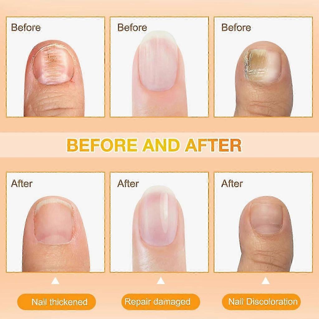 Bienenstich-Nagelreparaturserum, Natürliche Nagelpflege-Lösung, Zehennagel-Pflegespray, Beruhigende Nagelbehandlung, Anti-Pilz, 30ml