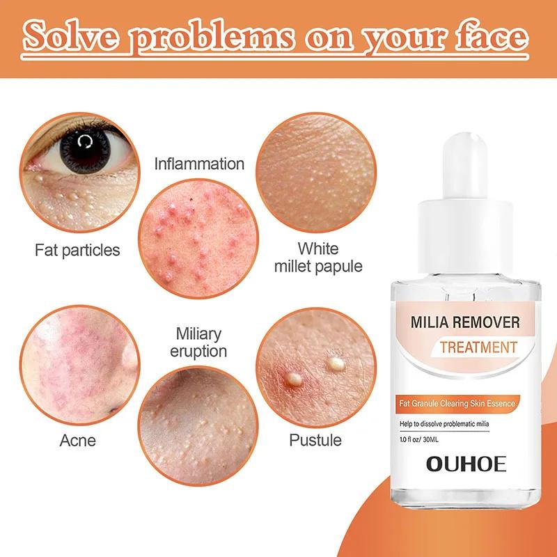 Fat Granules Removal Eye Serum Eye Milia Repair Treatment Products Wrinkle Lifting Moisturizing Anti-Puffiness Korean Skin Care