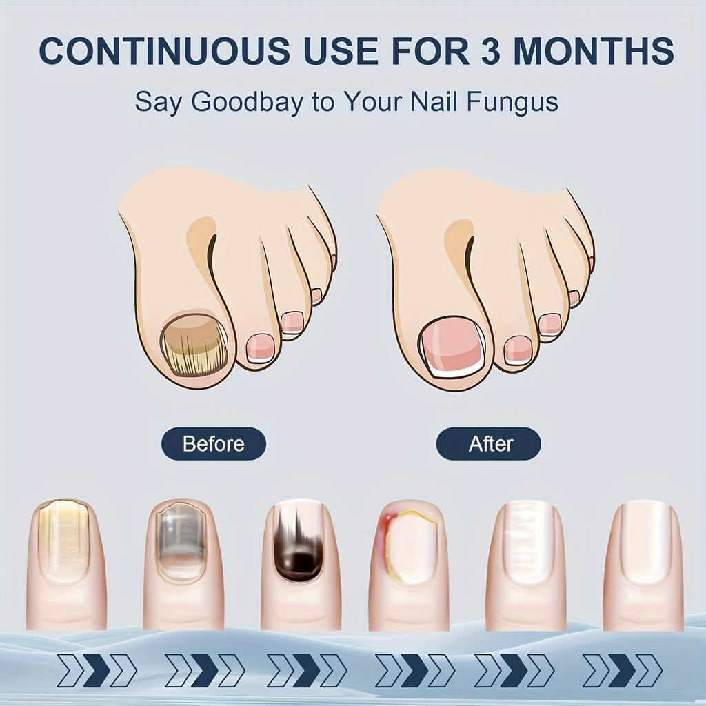 Laser neglesterilisator, 2 ganger rask muggfjerning og reparasjon, spesielt for negler med flere tær, sammenleggbart muggrengjøringsutstyr