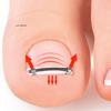 Curved Clamp Ingrown Toenail Pedicure Tool Toe Nail Care Straightening Correction Clip Embed Nail Care Tool for Toes