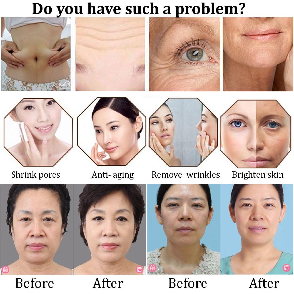 100-240v Cryo Heating Therapy Skin cool Electroporation Needle Free Mesotherapy Machine 50w Hot Cold Hammer Facial Anti Aging Beauty