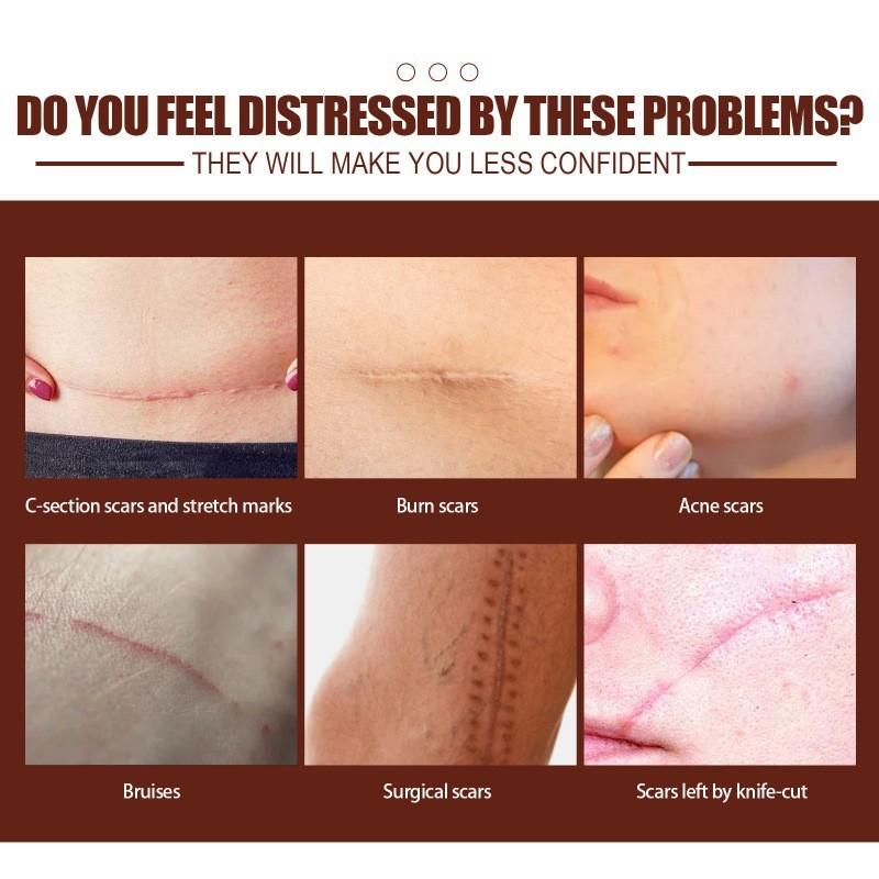 Ouhoe Scar Repair Cream For Effective Skin Scar Reduction And Healing Solutions