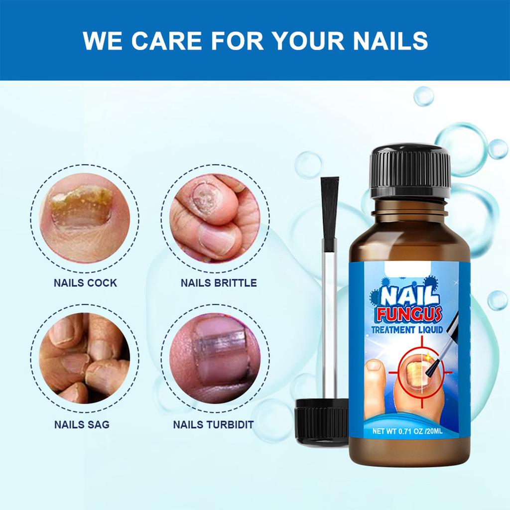 New Bright Potassium Care Liquid Onychomycosis Care Liquid New Bright Nails Onychomycosis Improves The Appearance Of Nails.20ML