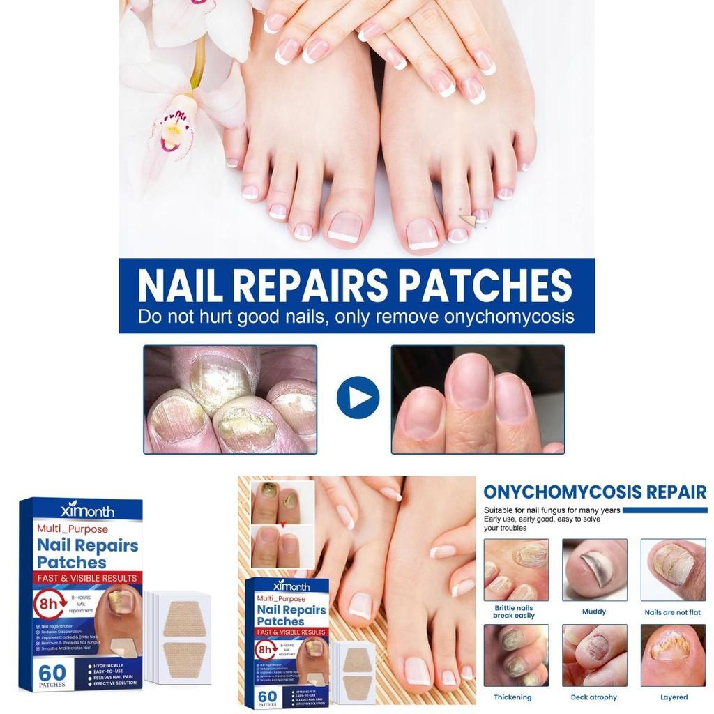 Ximonth Nagelreparaturpflaster zur Verdickung weicher Nägel und zur Behandlung von Nagelpilz mit 60 Pflastern